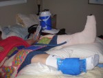 Highlight for Album: Laura left ankle surgery. Aug 12 2009.